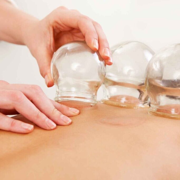 cupping therapy